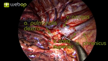 Preparation of the mediastinal pleura below the azygos vein
