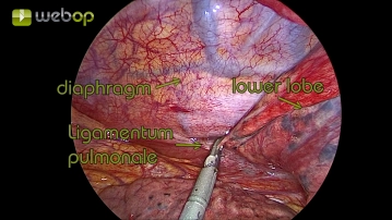 Preparation of the pulmonary ligament