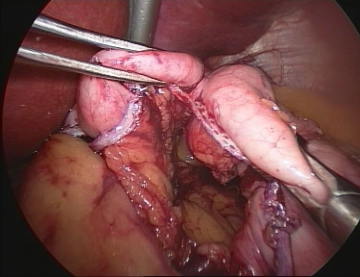 Start of the Operation and Gastric Pouch Formation