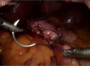 Parallel Fixation of the Loop at the Gastric Pouch