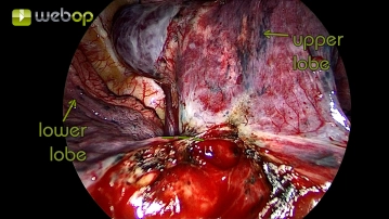 Dissection of the interlobium