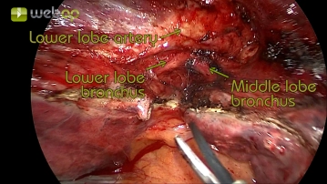 Exploration of the thorax and preparation of the pulmonary artery in the lobar fissure