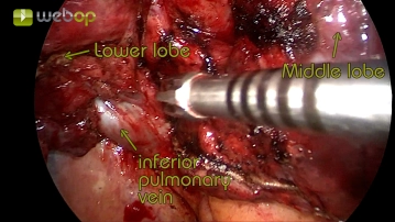 Preparation of the pulmonary ligament and visualization of the inferior pulmonary vein