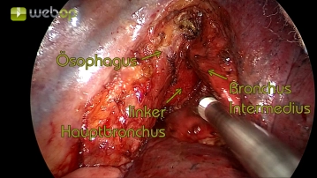 En-bloc resection of the lymph nodes of station 7 (according to IALSC)