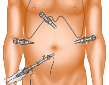 Positioning of the Trocars