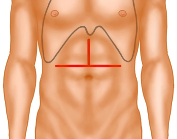 Transverse Upper Abdominal Laparotomy