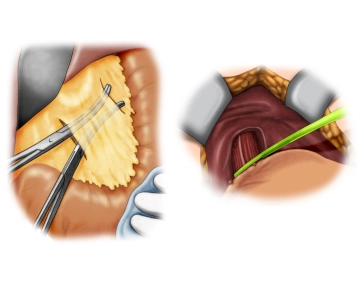Detachment of the lesser omentum; Preparation of the gastroesophageal junction