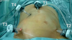 Creation of pneumoperitoneum / Placement of working trocars