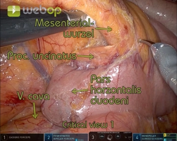Visualization of the uncinate process of the pancreas