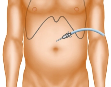Pneumoperitoneum, Trocar Placement, and Docking 1