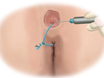 Excision of the External Fistula Ostium