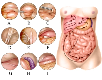 استرواح الصفاق (Pneumoperitoneum)، الاستكشاف