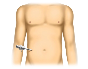 وضعية المريض، شق الجلد، استرواح الصفاق (Pneumoperitoneum)