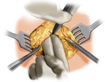Opening of the abdominal cavity