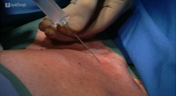 Infiltration of the Surgical Area with Local Anesthetic