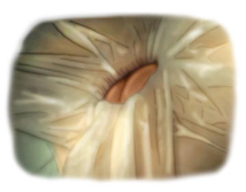Retraction of the skin edges