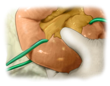 Defining the Resection Boundaries