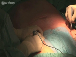 Bilateral exposure of the groin vessels