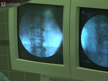 Placement of the stiff guidewire (from the left)