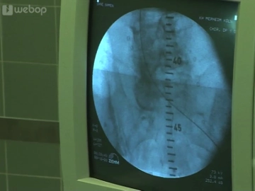 Placement of an angiography catheter (from the right)