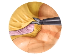 Mobilization of the descending colon