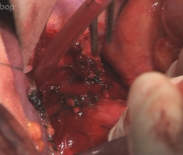 فتح الفتحة المريئية (Hiatus oesophageus) مع تحضير المريء البعيد