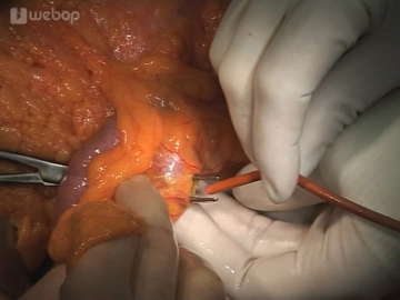 Determination of the oral resection margin