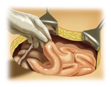Locating the Terminal Ileal Loop