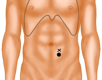 Marking the Stoma