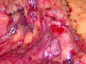 Preparation of the Ileocolic Vessels