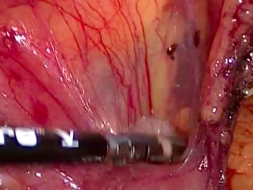 Preparation of Mesocolon and Mesentery