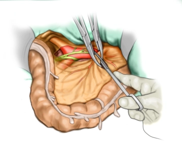 Central Transection of the Inferior Mesenteric Artery