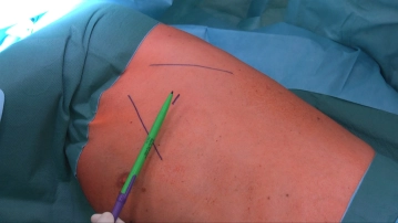 Skin Incision