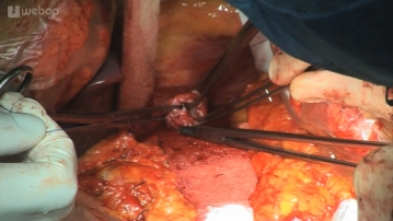 Tying in the anvil using a purse-string suture