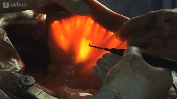 Assessment of the jejunal vascular arcades with determination of the length of the afferent limb