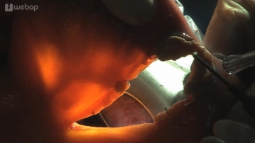 Preparation of the Roux-en-Y limb