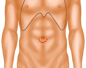 Skin Incision