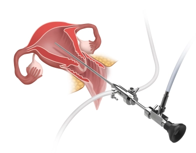 Hysteroscopy, fractional curettage