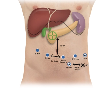 Pylorus-preserving pancreaticoduodenectomy, according to Longmire-Traverso, robotically assisted