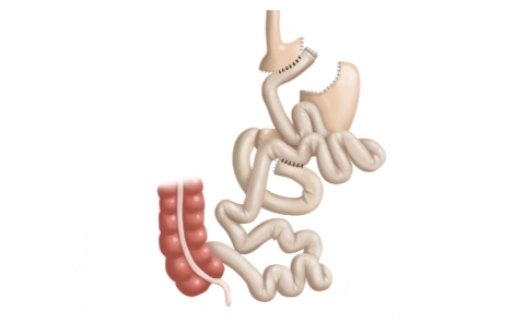 Gastric bypass, laparoscopic