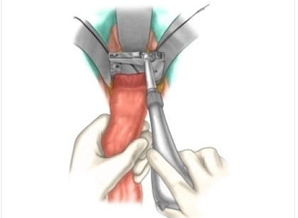 Anastomosis technique, gastrointestinal, circular stapled suture