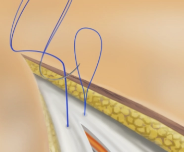 Abdominal wall closure - Techniques: loop suture and "small tissue bites"