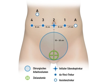 Trokarpositionierung und Docking
