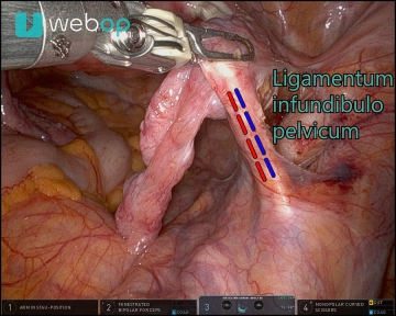 Adnexektomie rechts 1