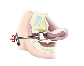 Narkoseuntersuchung und Anbringen eines Portioadapters