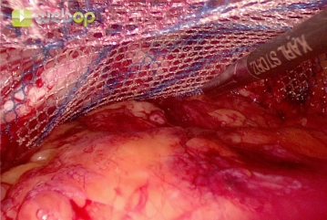 Platzieren der Netze