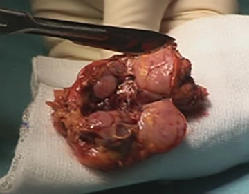 Entfernung des Präparates, Drainage