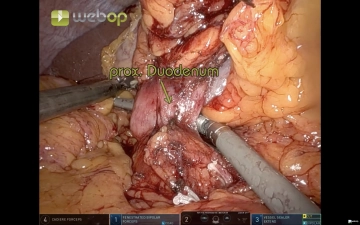 513 6 Absetzen Duodenum.jpg