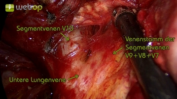 Präparation des Ligamentum pulmonale und Darstellung der unteren Lungenvene