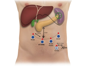 504-Trokare-2 beide Systeme.jpg